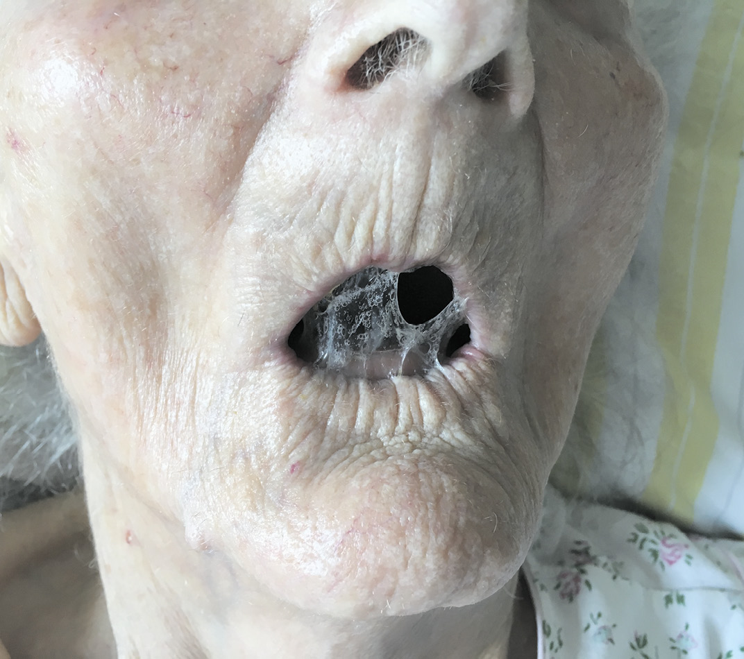 Beim Sterbenden ist gute Mundpflege wichtiger als eine subkutane Kochsalzinfusion! / Foto: Sitte
