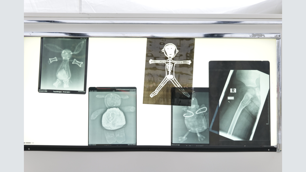 Gummibärchen verschluckt? Das Röntgenbild hilft bei der Aufklärung. Foto: Paviel Schertzer